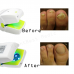 Nail Cleaning Laser Device Nail Fungus Treatment Cold Laser Physical Therapy Device